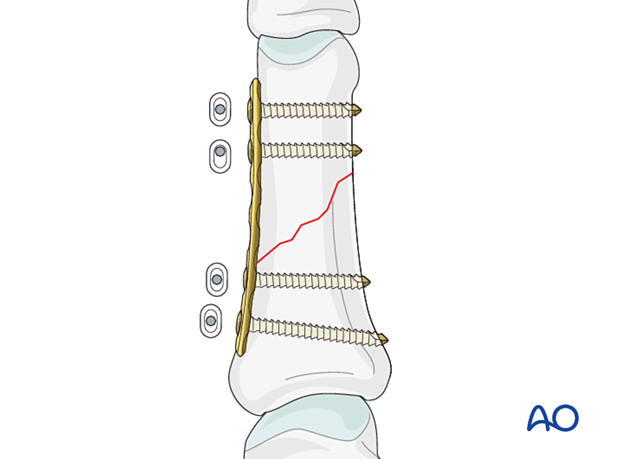 Compression plating of an oblique fracture of the proximal phalangeal shaft