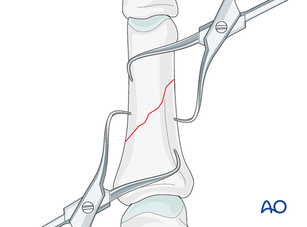 Reduction of an oblique fracture of the proximal phalangeal shaft with two forceps