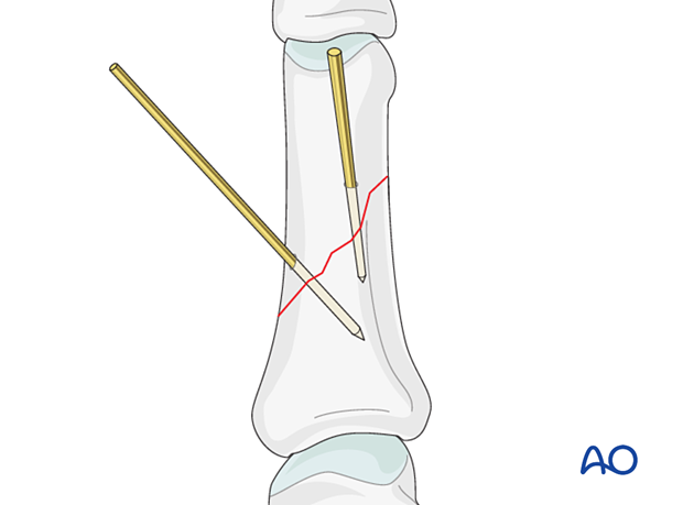 Preliminary fixation of an oblique fracture of the proximal phalangeal shaft with K-wires