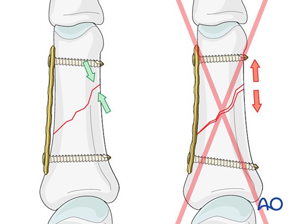 Compression plating of an oblique fracture of the proximal phalangeal shaft