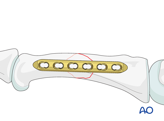 Compression plating of an oblique fracture of the proximal phalangeal shaft – plate positioning