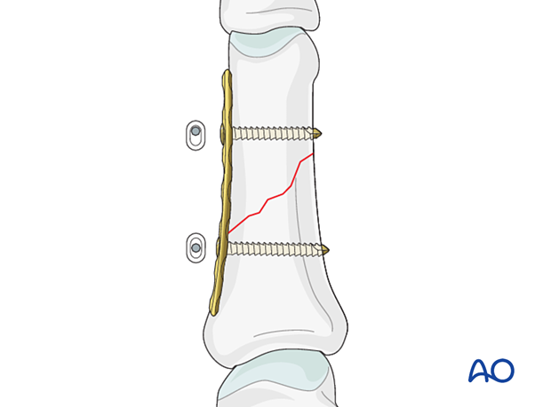 Compression plating of an oblique fracture of the proximal phalangeal shaft