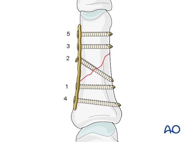 Compression plating of an oblique fracture of the proximal phalangeal shaft with a lag screw through the plate – order of screw insertion