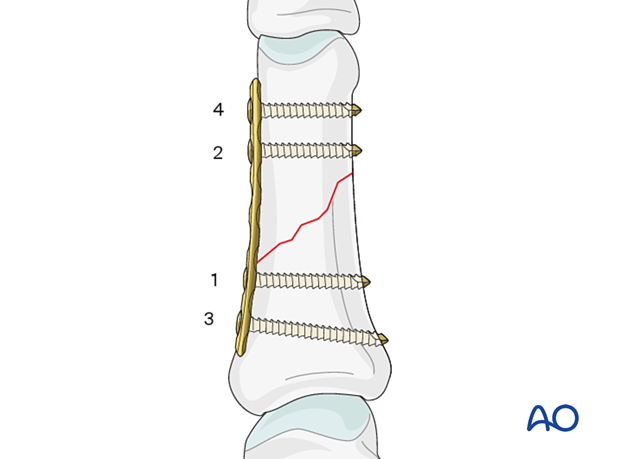 Compression plating of an oblique fracture of the proximal phalangeal shaft – order of screw insertion