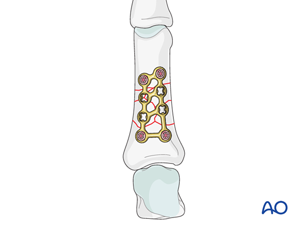 Bridge plating of a multifragmentary fracture of the proximal phalangeal shaft with a strut plate
