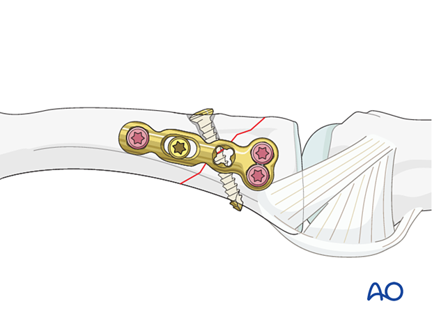 Lag-screw fixation with a neutralization plate of an oblique extraarticular fracture of the proximal phalangeal base