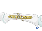 Lag-screw fixation with a neutralization plate of an oblique fracture of the proximal phalangeal shaft