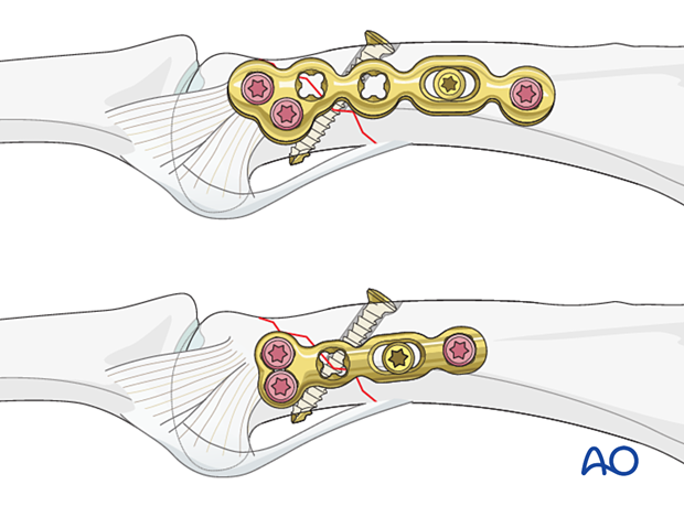 Lag-screw fixation with a neutralization plate of an oblique extraarticular fracture of the proximal phalangeal head