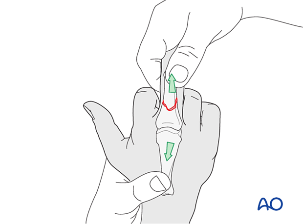 Closed reduction of an oblique fracture of the proximal phalangeal shaft