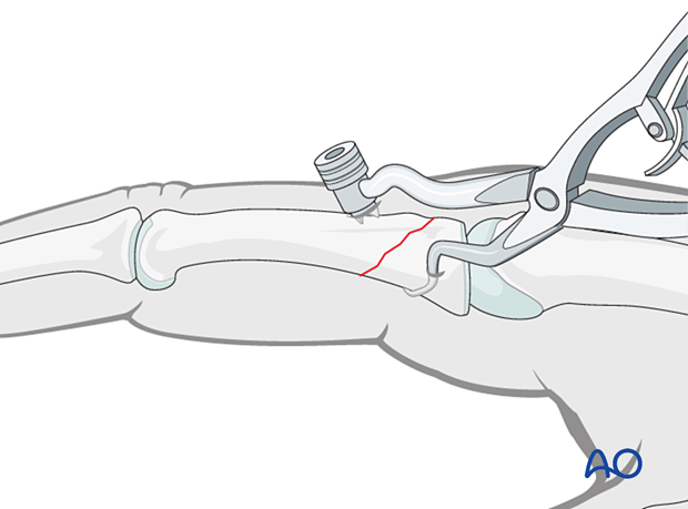 Holding the reduction of an oblique extraarticular fracture of the proximal phalangeal base with forceps for percutaneous screw insertion
