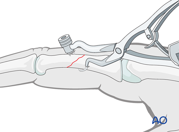 Holding the reduction of an oblique fracture of the proximal phalangeal shaft with forceps for percutaneous screw insertion