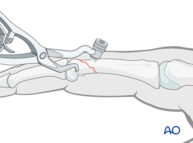 Holding the reduction of an oblique extraarticular fracture of the proximal phalangeal head with forceps for percutaneous screw insertion