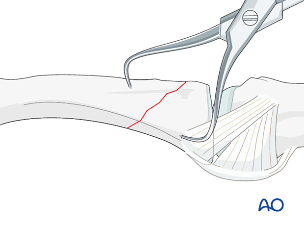 Holding the reduction of an oblique extraarticular fracture of the proximal phalangeal base with forceps 