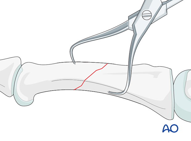 Holding the reduction of an oblique fracture of the proximal phalangeal shaft with forceps