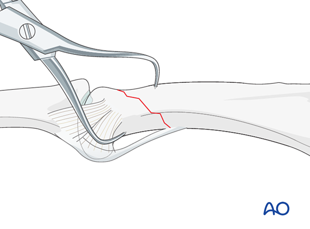 Holding the reduction of an oblique extraarticular fracture of the proximal phalangeal head with forceps