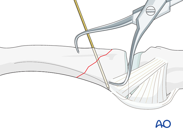 Holding the reduction of an oblique extraarticular fracture of the proximal phalangeal base with forceps and a preliminary K-wire