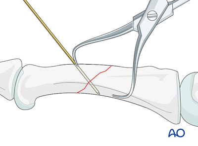 Lag-screw fixation with a neutralization plate for Oblique fracture of ...