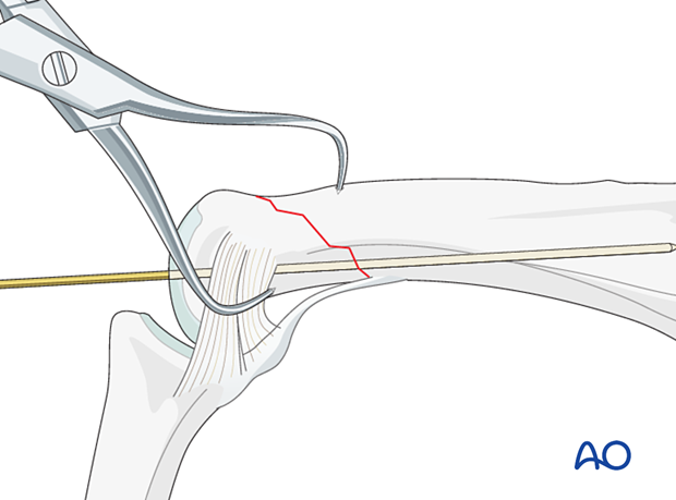 Holding the reduction of an oblique extraarticular fracture of the proximal phalangeal head with forceps and a preliminary K-wire