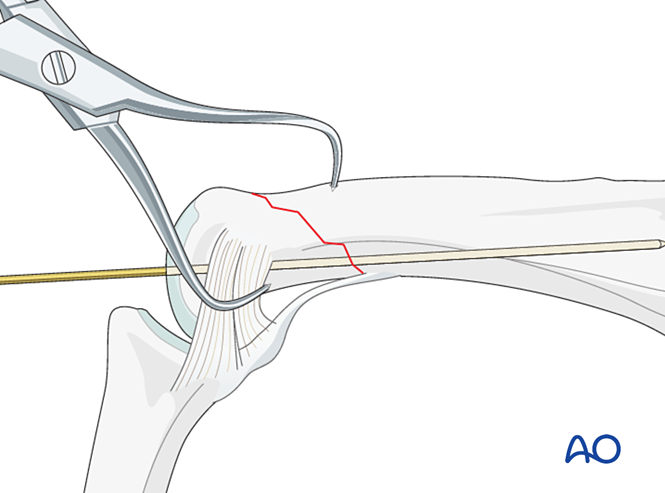 Lag-screw fixation with a neutralization plate for Oblique ...