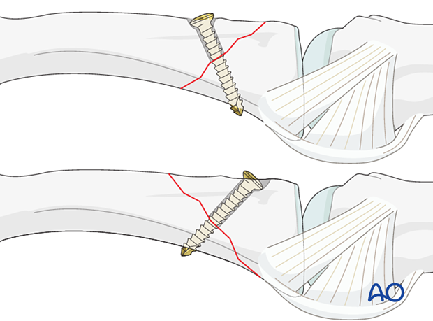 Lag-screw fixation of an oblique extraarticular fracture of the proximal phalangeal base