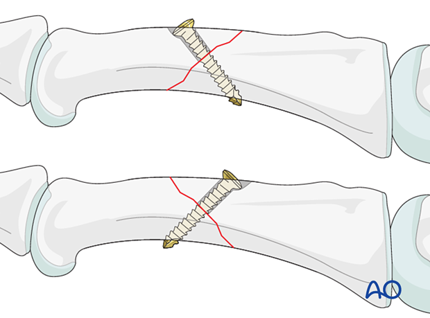 Lag-screw fixation of an oblique fracture of the proximal phalangeal shaft