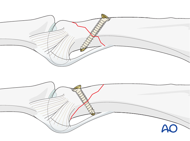 Lag-screw fixation of an oblique extraarticular fracture of the proximal phalangeal head