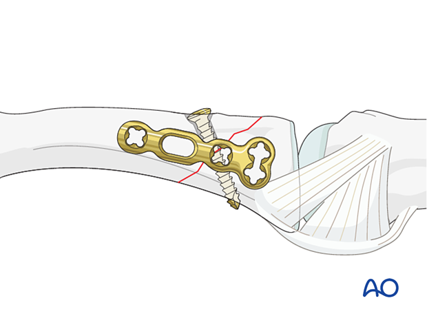 Lag-screw fixation with a neutralization plate of an oblique extraarticular fracture of the proximal phalangeal base – application of the plate