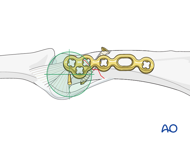 Lag-screw fixation with a neutralization plate of an oblique extraarticular fracture of the proximal phalangeal head – Plate application