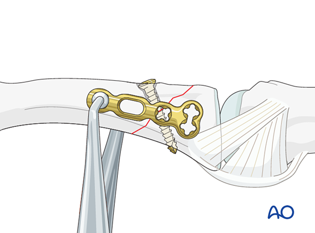 Lag-screw fixation with a neutralization plate of an oblique extraarticular fracture of the proximal phalangeal base – application of the plate