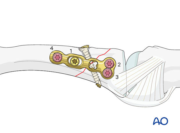 Lag-screw fixation with a neutralization plate of an oblique extraarticular fracture of the proximal phalangeal base – Order of screw insertion in the plate