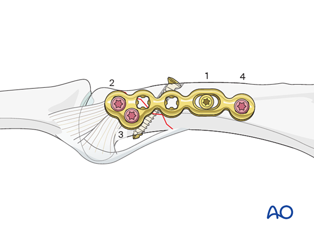 Lag-screw fixation with a neutralization plate of an oblique extraarticular fracture of the proximal phalangeal head – Order of screw insertion