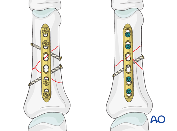 Lag-screw and plate fixation of a wedge fracture of the proximal phalangeal shaft