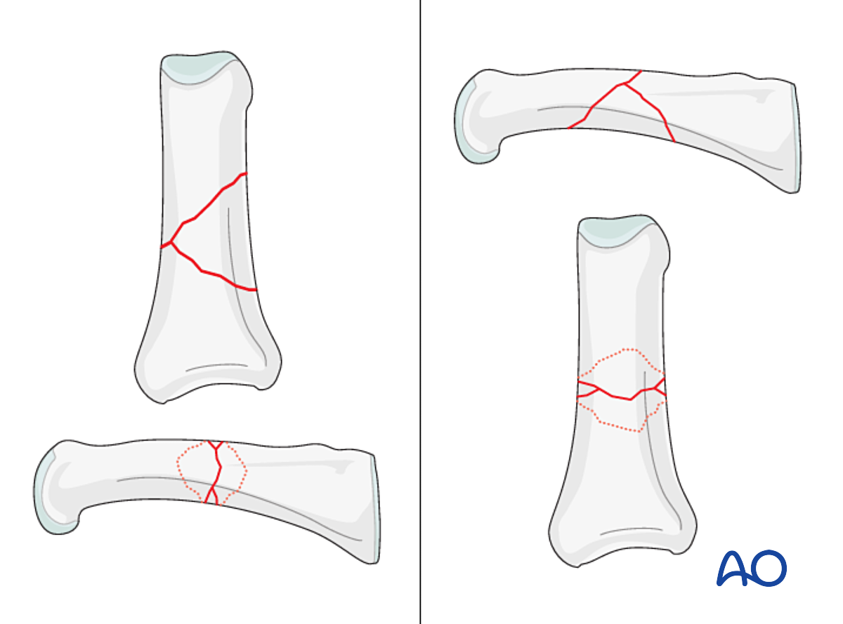 Lag-screw And Plate Fixation For Wedge/multifragmentary Fracture Of The ...