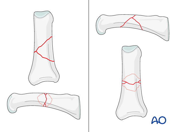 Wedge fracture of the proximal phalangeal shaft