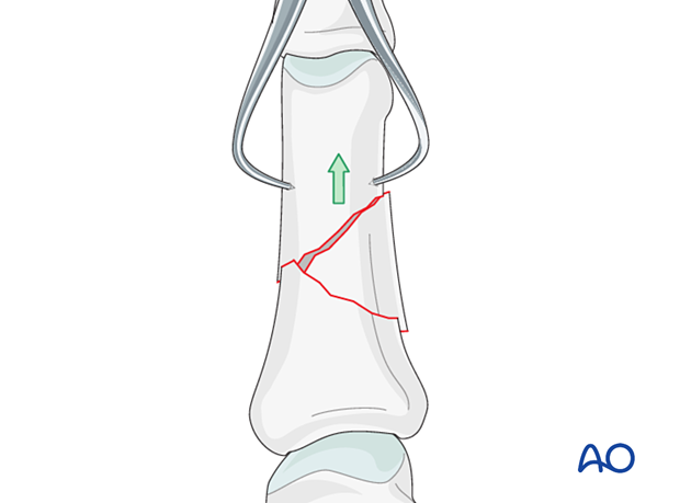 Reduction of a wedge fracture of the proximal phalangeal shaft