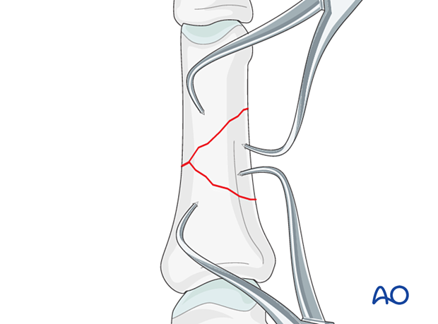 Holding a reduction of a wedge fracture of the proximal phalangeal shaft with reduction forceps