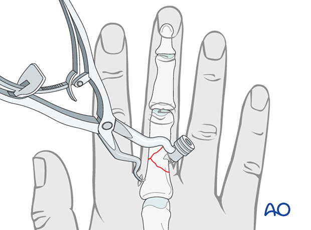 Holding a reduction of a wedge fracture of the proximal phalangeal shaft with percutaneous reduction forceps