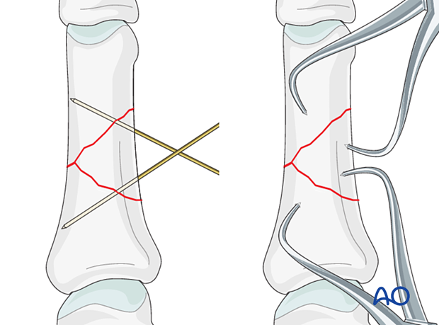 Holding a reduction of a wedge fracture of the proximal phalangeal shaft with rK-wires or eduction forceps