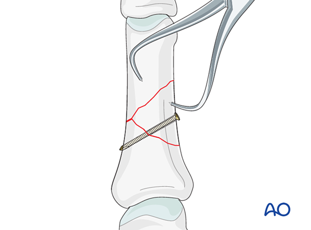 Lag-screw fixation of a wedge fracture of the proximal phalangeal shaft 