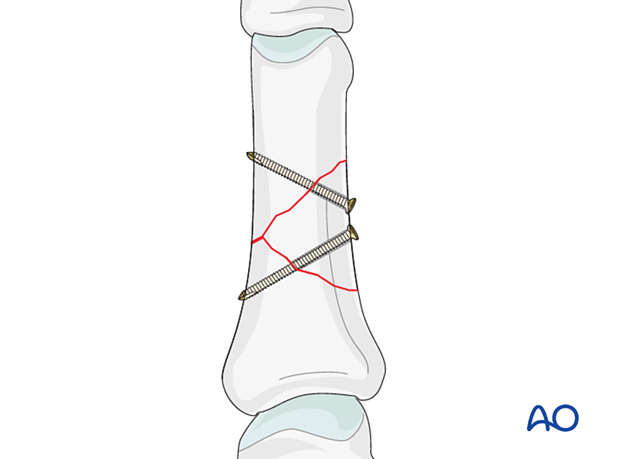 Lag-screw fixation of a wedge fracture of the proximal phalangeal shaft