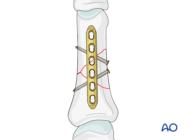 Lag-screw and plate fixation of a wedge fracture of the proximal phalangeal shaft – plate positioning