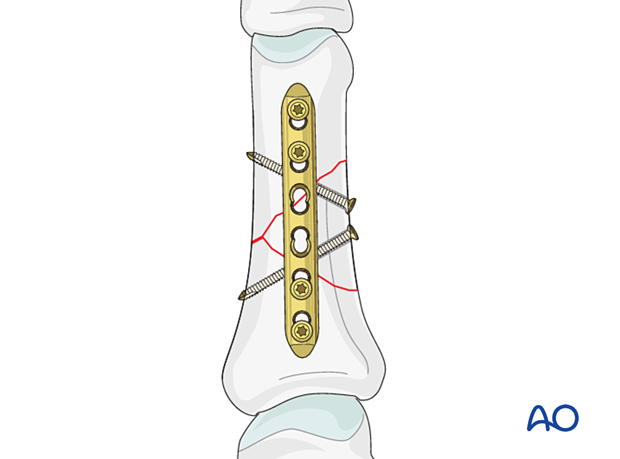 Lag-screw and plate fixation of a wedge fracture of the proximal phalangeal shaft