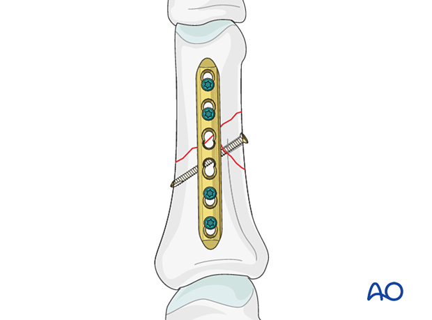 Lag-screw and plate fixation of a wedge fracture of the proximal phalangeal shaft