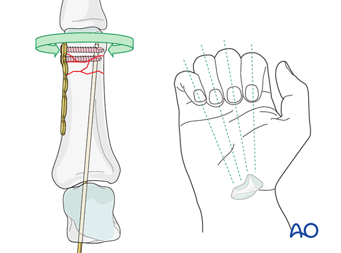 Bridge plating for Wedge/multifragmentary extraarticular fracture of ...