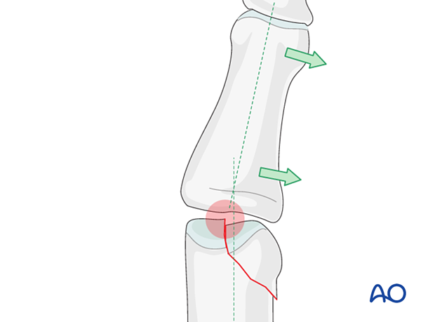 Unicondylar depression may lead to angulation of the finger in articular phalangeal fractures – hand.