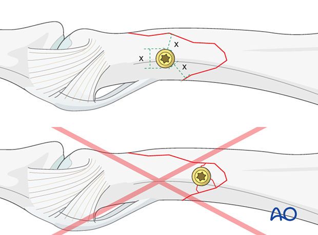 Correct versus incorrect screw placement – large fragment of an oblique distal condylar fracture of the proximal phalanx – hand