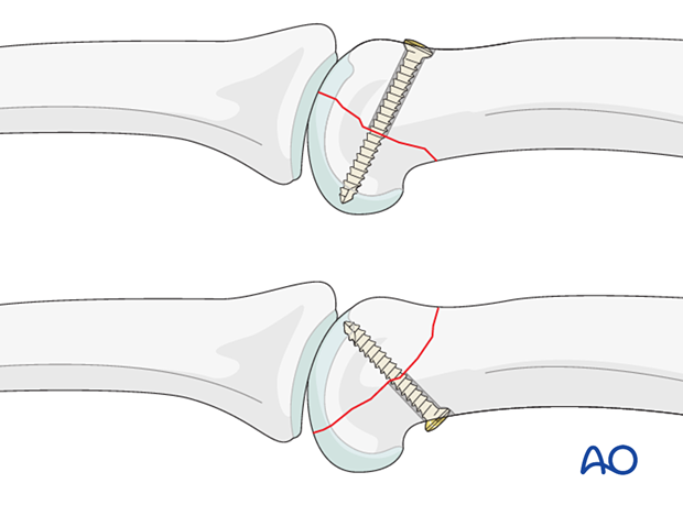 Fixation with a cortical lag screw of a volar and a dorsal coronal fragment of a unicondylar fracture dislocation of proximal phalanx joint – hand.