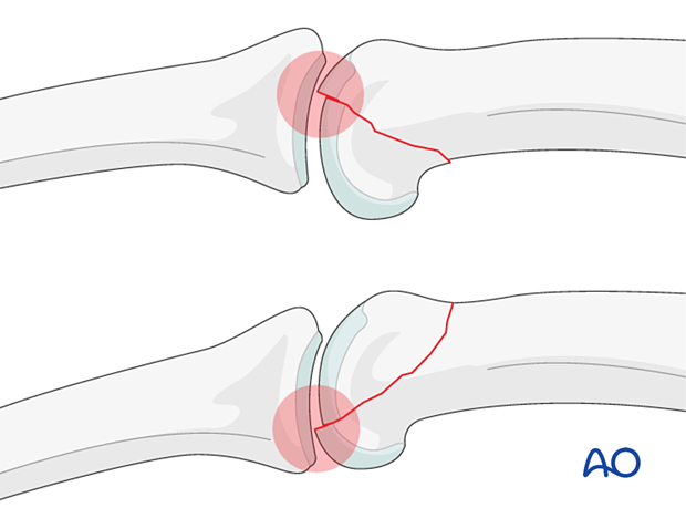 Unicondylar fracture-dislocations of the proximal phalanx proximal interphalangeal joint – hand.