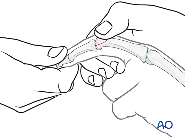 Reduction by traction of a dorsal unicondylar fracture-dislocation of the proximal phalanx proximal interphalangeal joint – hand.