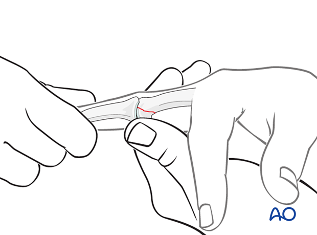 Reduction by traction of a volar unicondylar fracture-dislocation of the proximal phalanx proximal interphalangeal joint – hand.